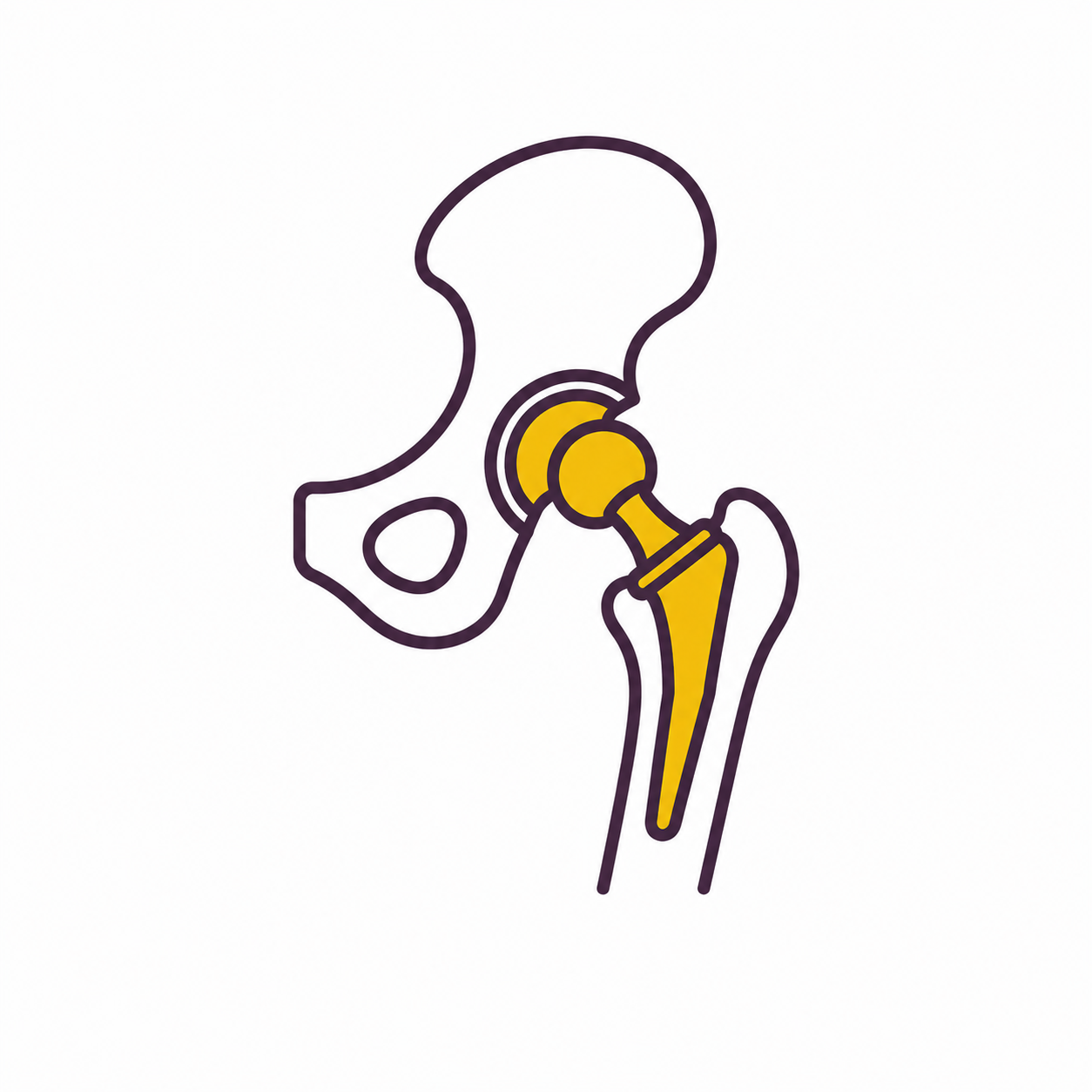 Hip Replacement