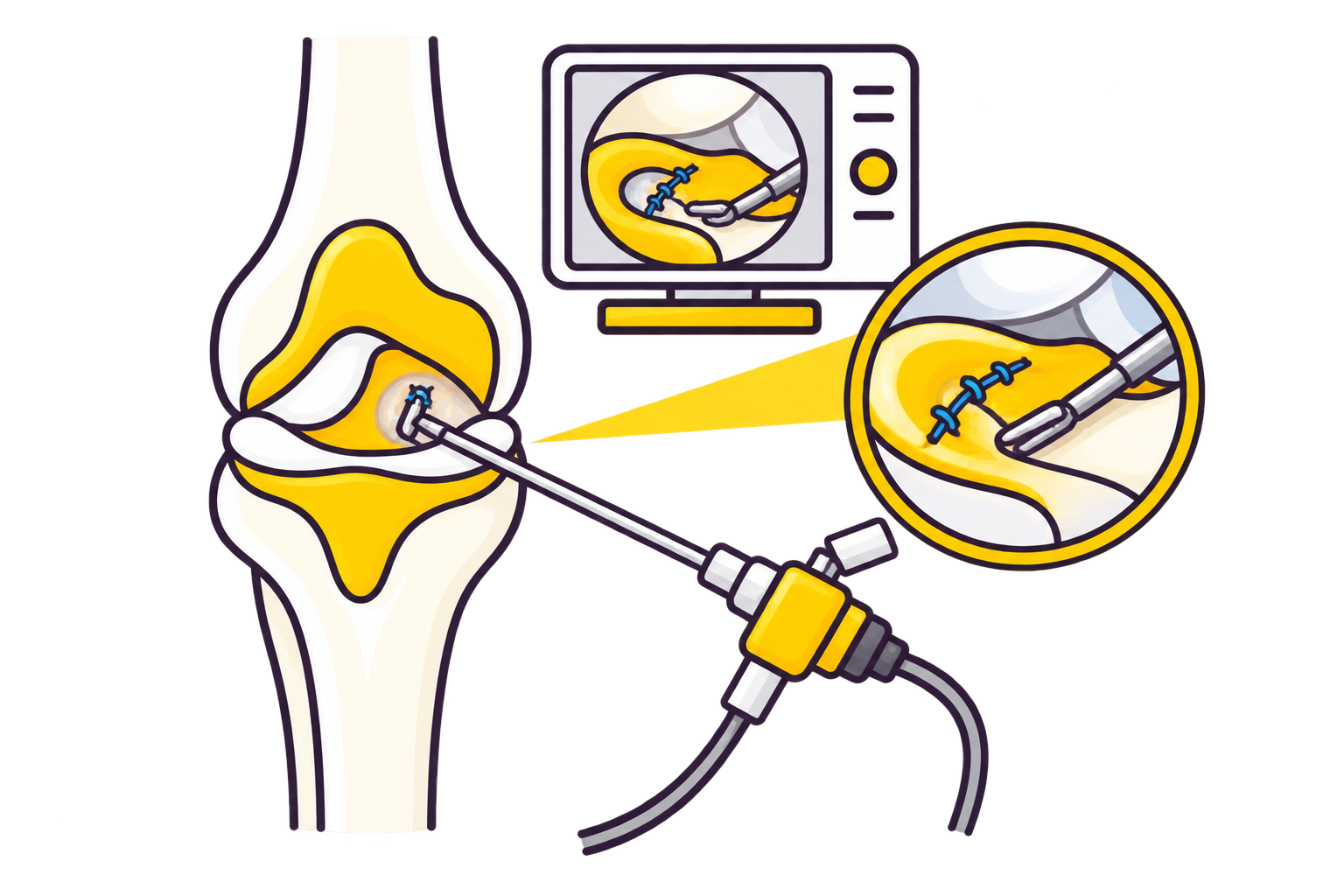 Meniscus Repair