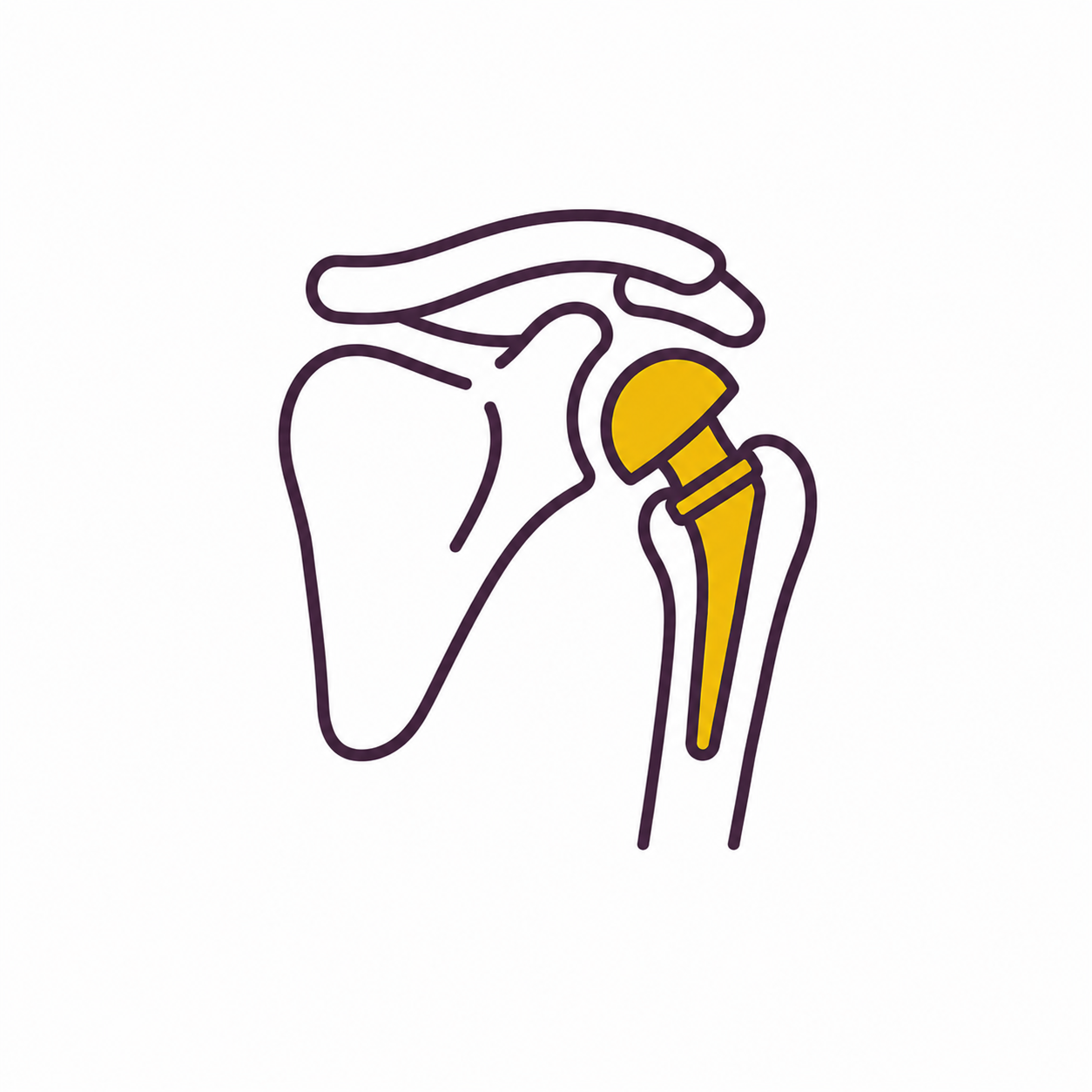 Shoulder Replacement
